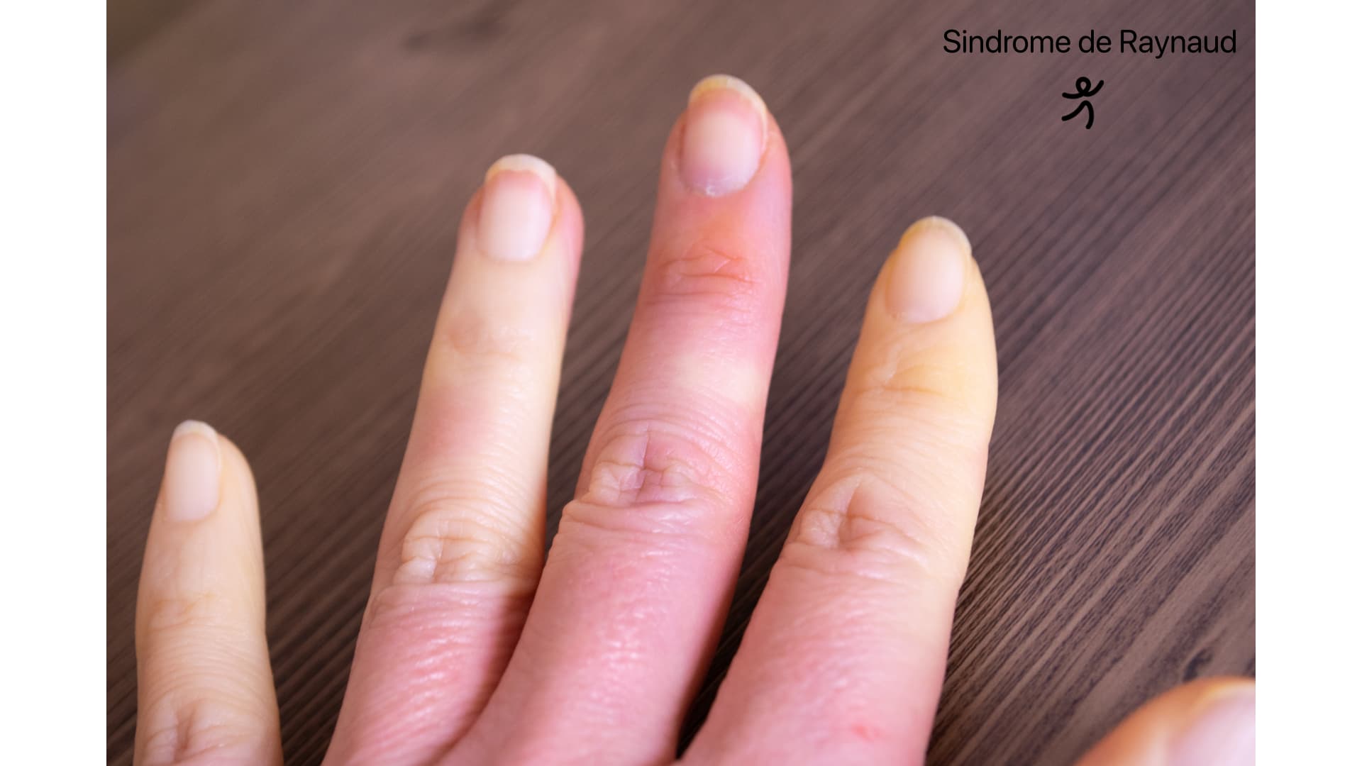 Sindrome de Raynaud