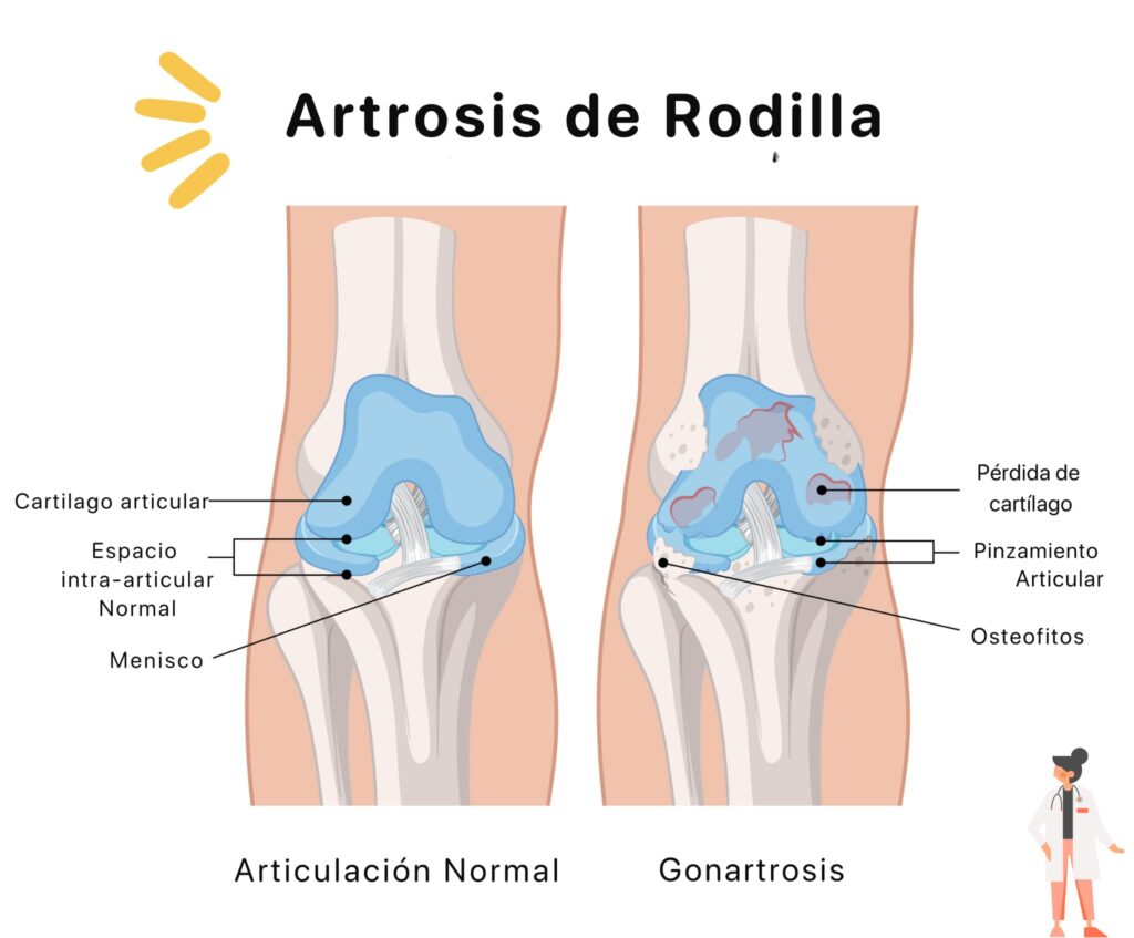Artrosis De rodilla