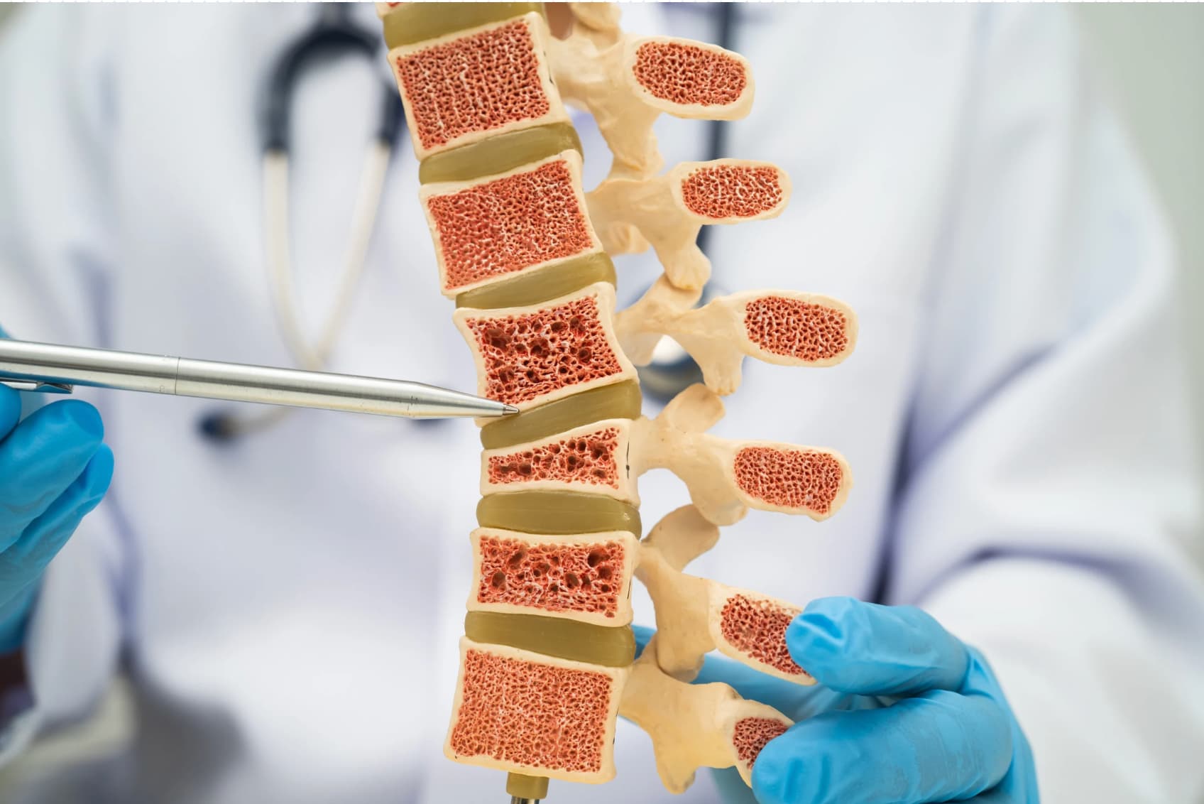 Osteoporosis